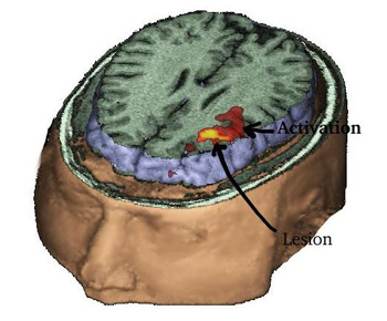 tripleVG_Tumor.jpg