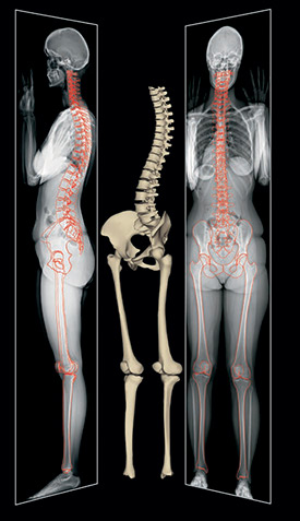 EOS machine scan bones EOS machine scan bones