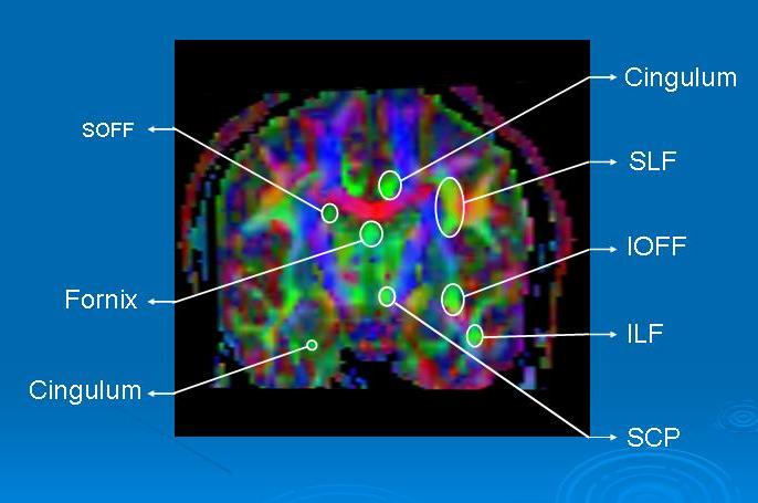 FA_map_coronal.jpg